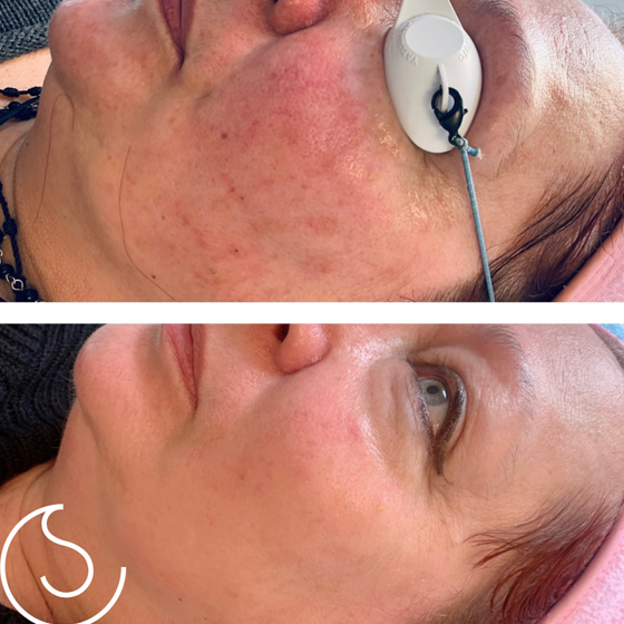 Laser Skin Rejuvenation