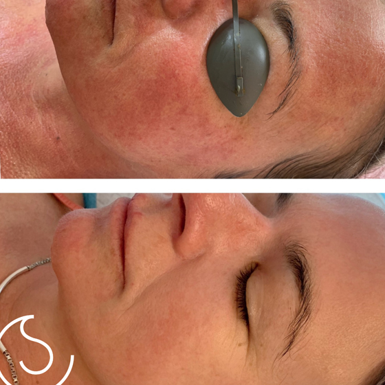 Laser Skin Rejuvenation
