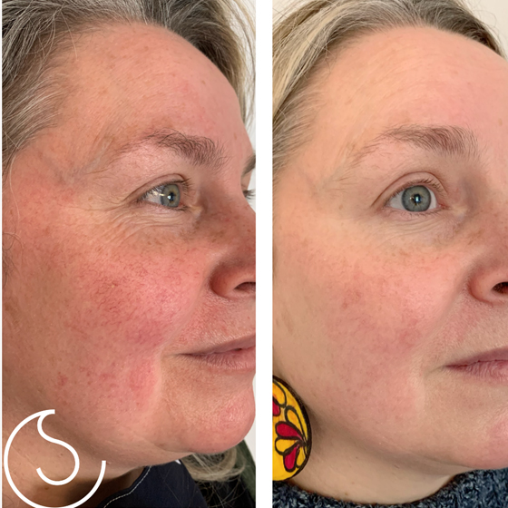Laser Skin Rejuvenation