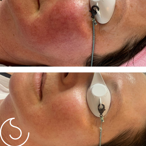 Laser Skin Rejuvenation