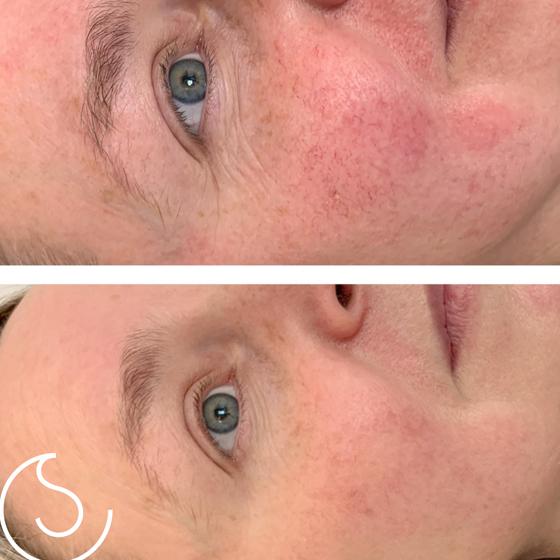 Laser Skin Rejuvenation