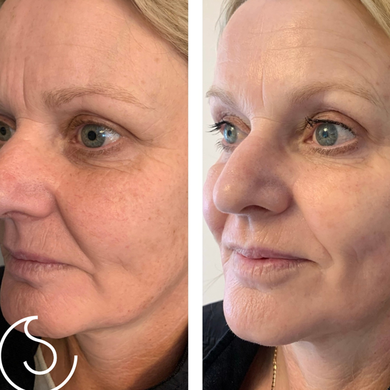 4D Hifu & Laser ( Non Surgical makeovers)