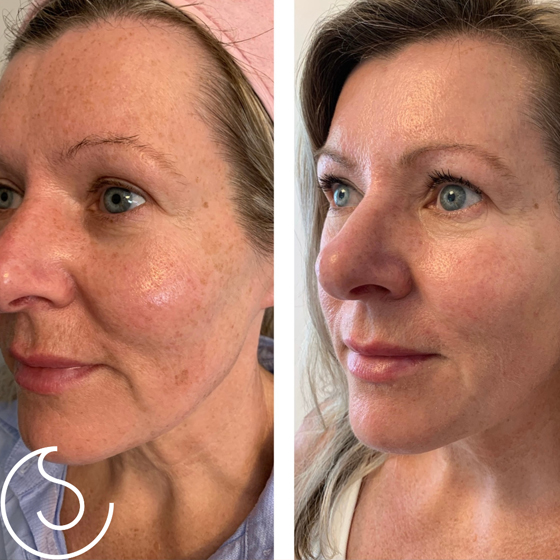 Laser Skin Rejuvenation