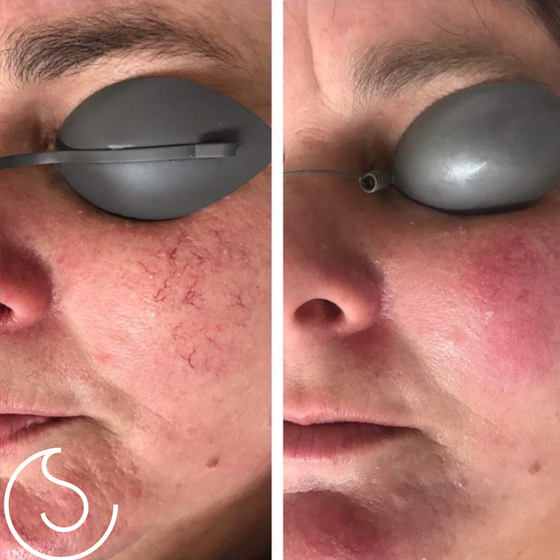 Laser Skin Rejuvenation