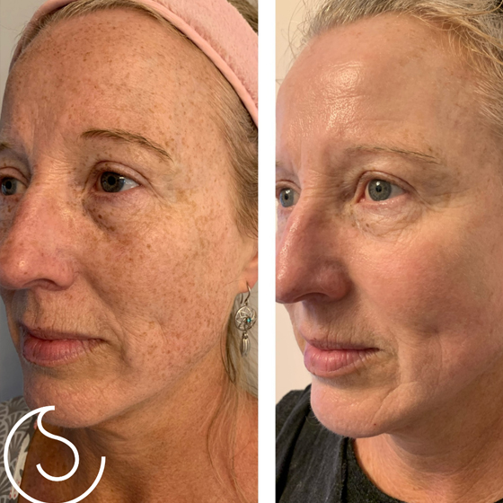 4D Hifu & Laser ( Non Surgical makeovers)