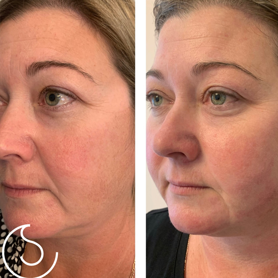 4D Hifu & Laser ( Non Surgical makeovers)
