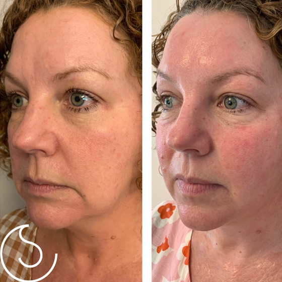 4D Hifu & Laser ( Non Surgical makeovers)