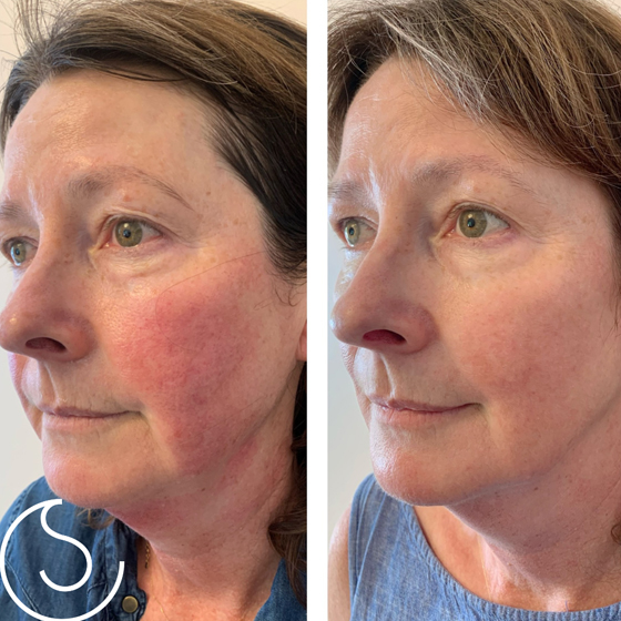 Laser Skin Rejuvenation