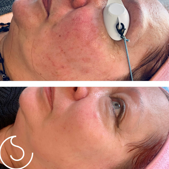 Laser Skin Rejuvenation